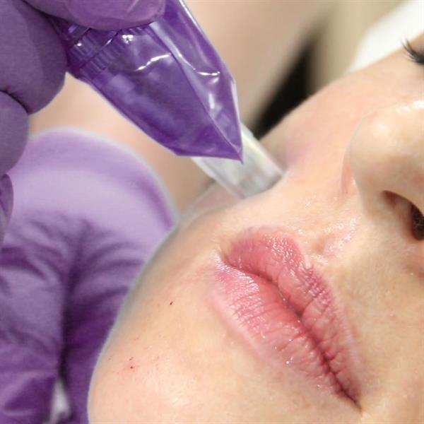 MyFiller Hyaluronfiller Revitalize